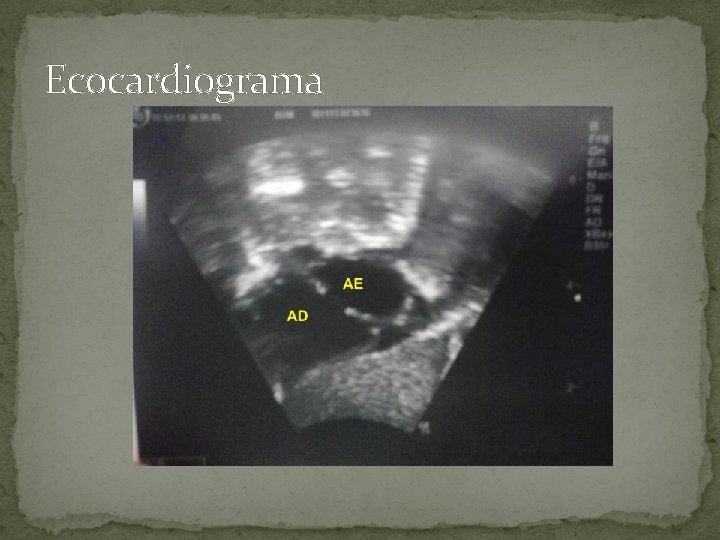 Ecocardiograma 