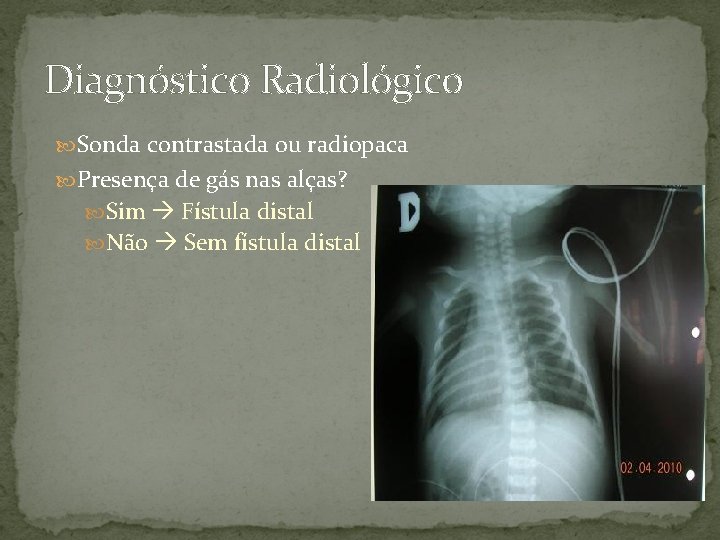 Diagnóstico Radiológico Sonda contrastada ou radiopaca Presença de gás nas alças? Sim Fístula distal