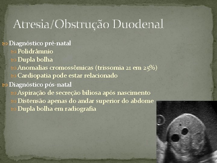 Atresia/Obstrução Duodenal Diagnóstico pré-natal Polidrâmnio Dupla bolha Anomalias cromossômicas (trissomia 21 em 25%) Cardiopatia