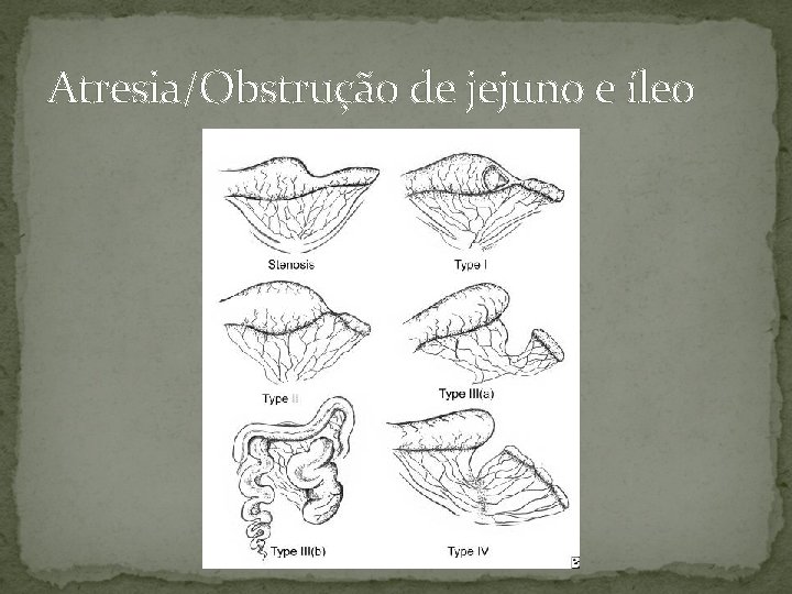 Atresia/Obstrução de jejuno e íleo 