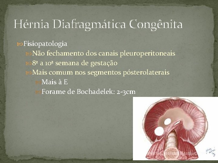 Hérnia Diafragmática Congênita Fisiopatologia Não fechamento dos canais pleuroperitoneais 8ª a 10ª semana de