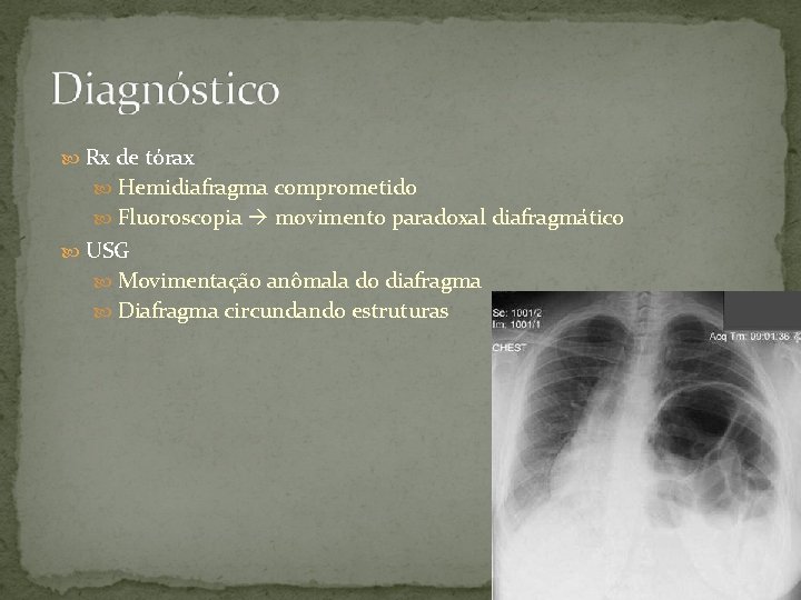  Rx de tórax Hemidiafragma comprometido Fluoroscopia movimento paradoxal diafragmático USG Movimentação anômala do