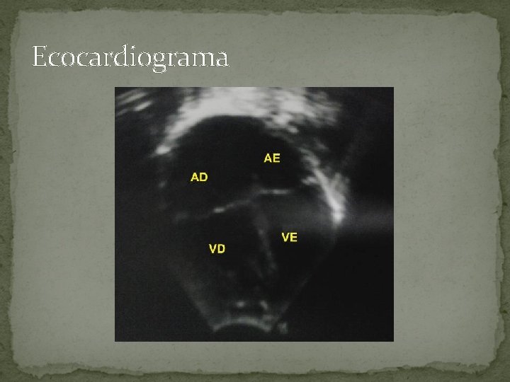 Ecocardiograma 