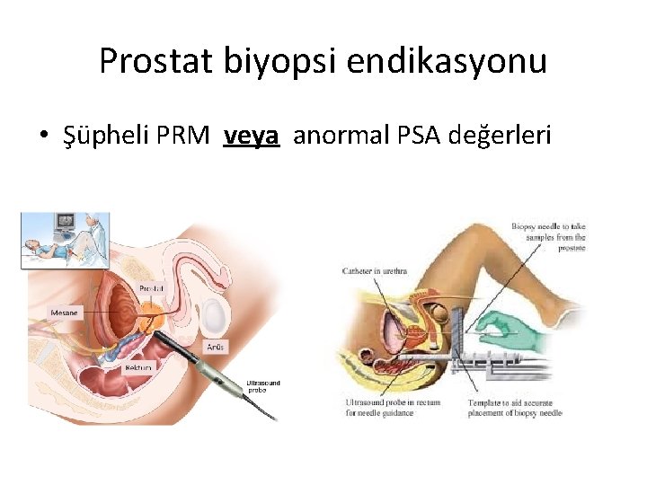 Prostat biyopsi endikasyonu • Şüpheli PRM veya anormal PSA değerleri 