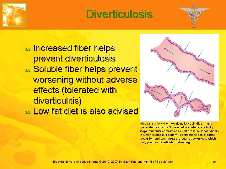 Diverticulosis Increased fiber helps prevent diverticulosis Soluble fiber helps prevent worsening without adverse effects