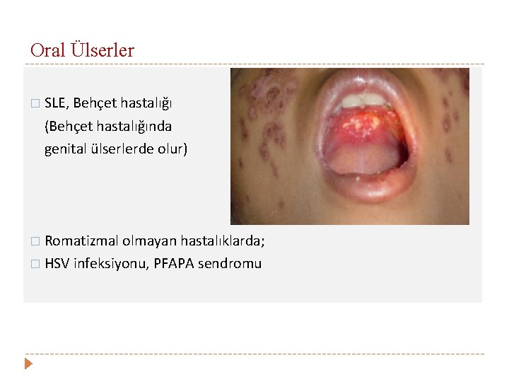 Oral Ülserler � SLE, Behçet hastalığı (Behçet hastalığında genital ülserlerde olur) � Romatizmal olmayan