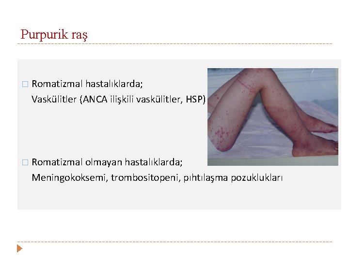 Purpurik raş � Romatizmal hastalıklarda; Vaskülitler (ANCA ilişkili vaskülitler, HSP) � Romatizmal olmayan hastalıklarda;