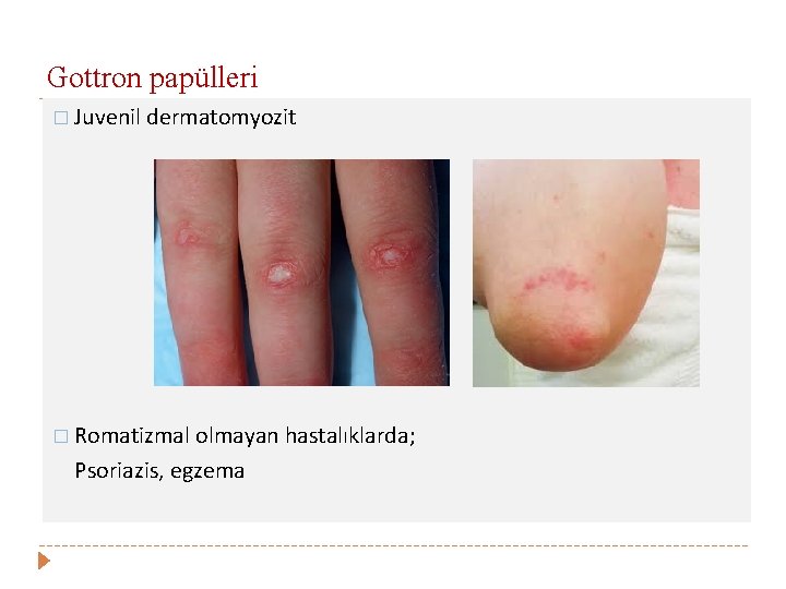 Gottron papülleri � Juvenil dermatomyozit � Romatizmal olmayan hastalıklarda; Psoriazis, egzema 