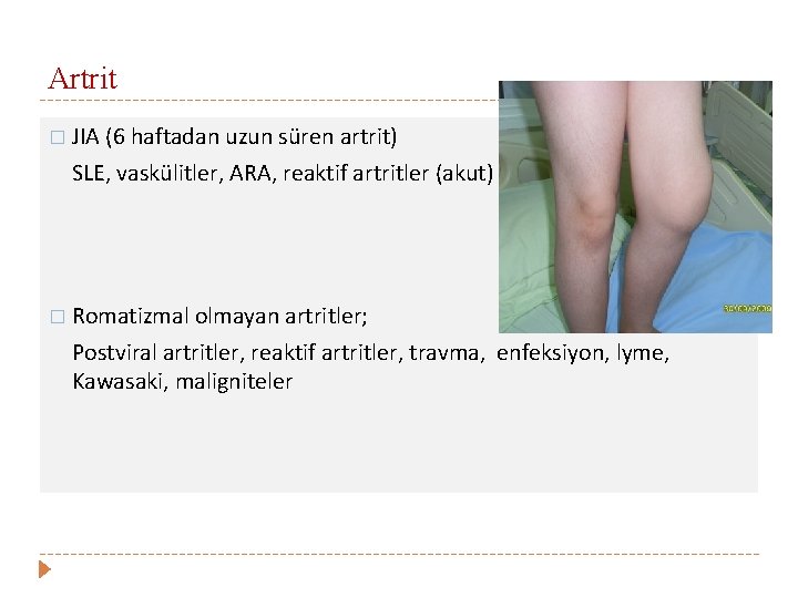 Artrit � JIA (6 haftadan uzun süren artrit) SLE, vaskülitler, ARA, reaktif artritler (akut)
