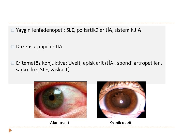 � Yaygın lenfadenopati: SLE, poliartiküler JİA, sistemik JİA � Düzensiz pupiller JİA � Eritematöz