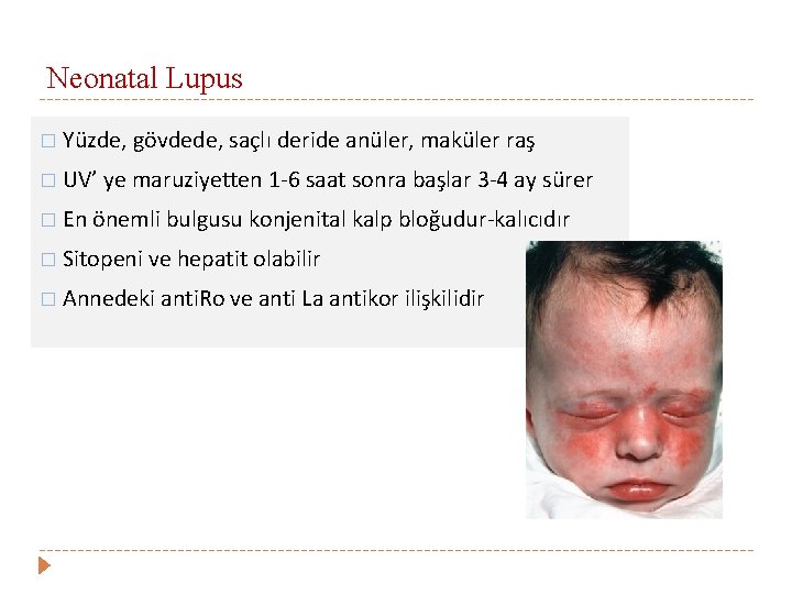 Neonatal Lupus � Yüzde, gövdede, saçlı deride anüler, maküler raş � UV’ ye maruziyetten