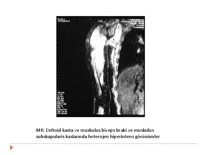 MR: Deltoid kasta ve muskulus biceps braki ve muskulus subskapularis kaslarında heterojen hiperintens görünümler