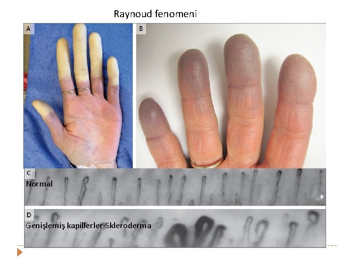 Raynoud fenomeni Normal Genişlemiş kapillerler-Skleroderma 