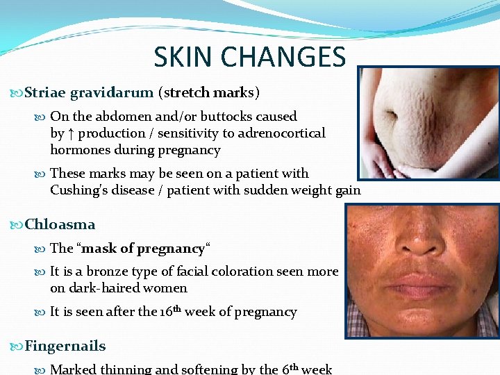 SKIN CHANGES Striae gravidarum (stretch marks) On the abdomen and/or buttocks caused by ↑