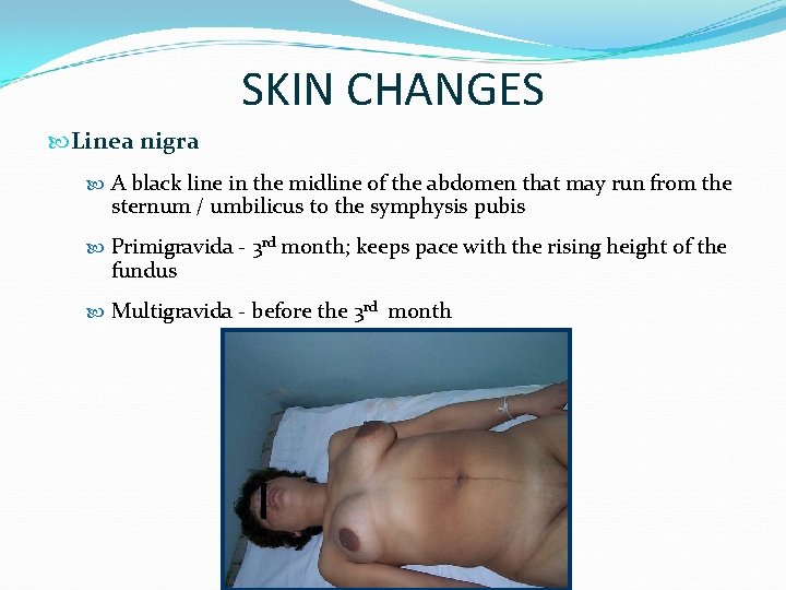 SKIN CHANGES Linea nigra A black line in the midline of the abdomen that