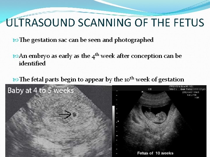 ULTRASOUND SCANNING OF THE FETUS The gestation sac can be seen and photographed An