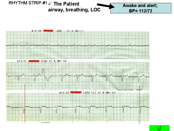 RHYTHM STRIP #1 ü The Patient airway, breathing, LOC Awake and alert; BP= 112/72