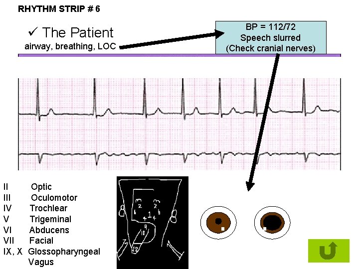 RHYTHM STRIP # 6 ü The Patient airway, breathing, LOC II IV V VI
