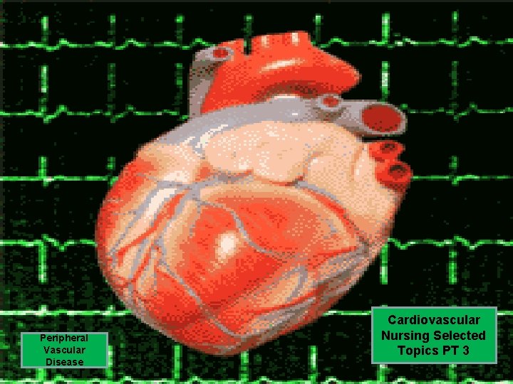 Peripheral Vascular Disease Cardiovascular Nursing Selected Topics PT 3 