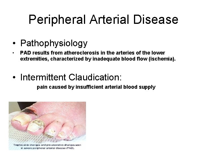 Peripheral Arterial Disease • Pathophysiology • PAD results from atheroclerosis in the arteries of