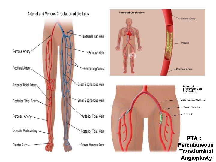 PTA : Percutaneous Transluminal Angioplasty 