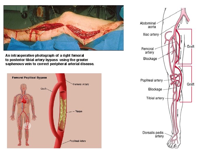 An intraoperative photograph of a right femoral to posterior tibial artery bypass using the