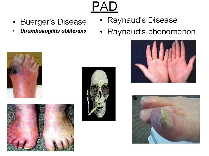 PAD • Buerger’s Disease • thromboangiitis obliterans • Raynaud’s Disease • Raynaud’s phenomenon 