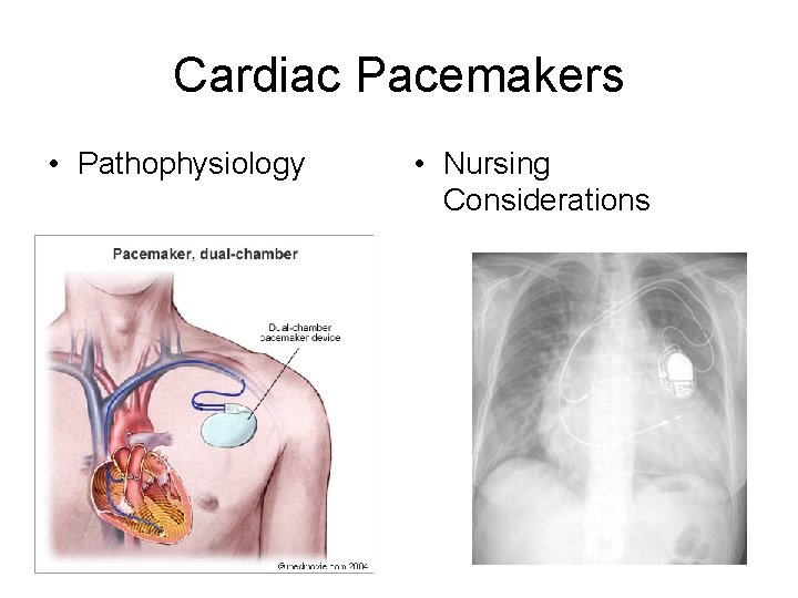 Cardiac Pacemakers • Pathophysiology • Nursing Considerations 