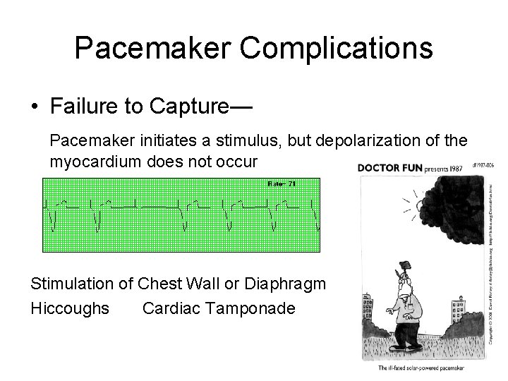 Pacemaker Complications • Failure to Capture— Pacemaker initiates a stimulus, but depolarization of the