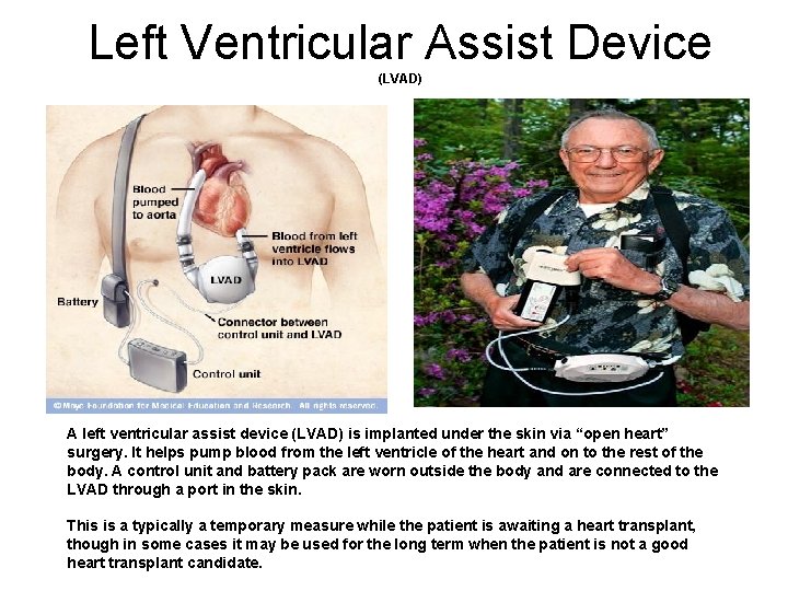 Left Ventricular Assist Device (LVAD) A left ventricular assist device (LVAD) is implanted under