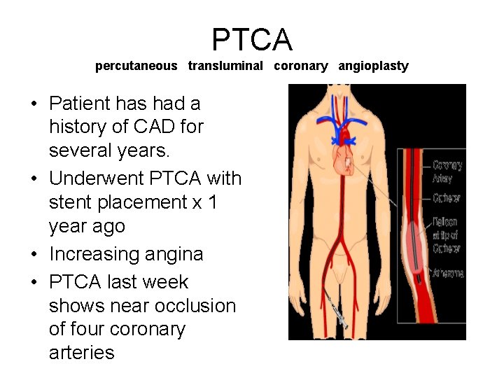PTCA percutaneous transluminal coronary angioplasty • Patient has had a history of CAD for