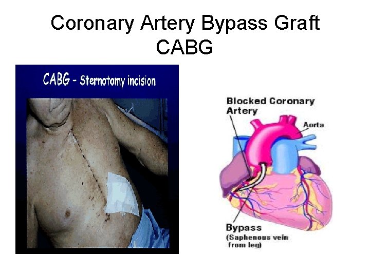Coronary Artery Bypass Graft CABG 