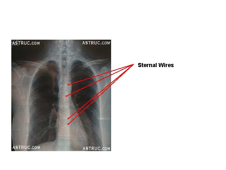 Sternal Wires 