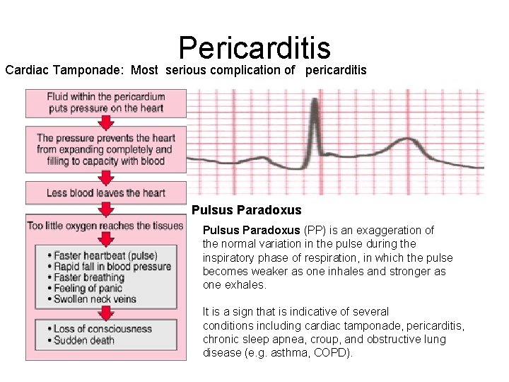 Pericarditis Cardiac Tamponade: Most serious complication of pericarditis Pulsus Paradoxus (PP) is an exaggeration