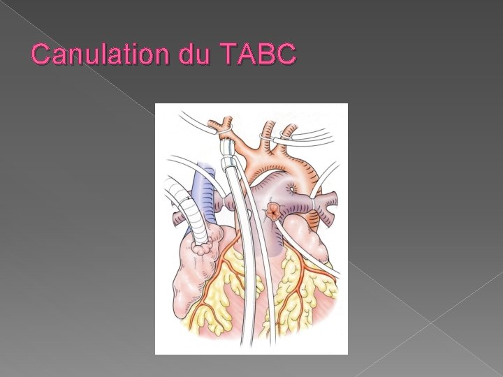 Canulation du TABC 