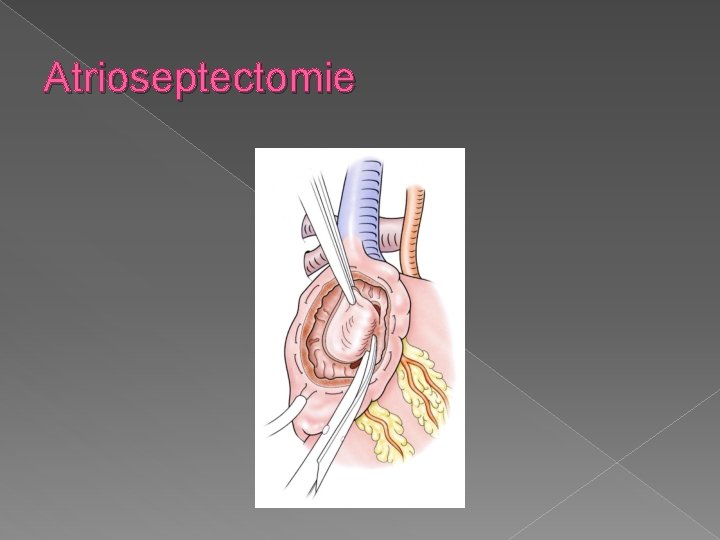 Atrioseptectomie 