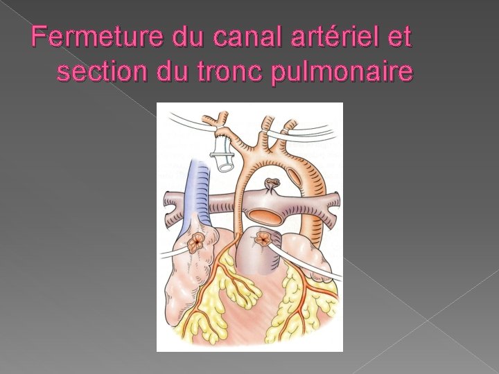 Fermeture du canal artériel et section du tronc pulmonaire 