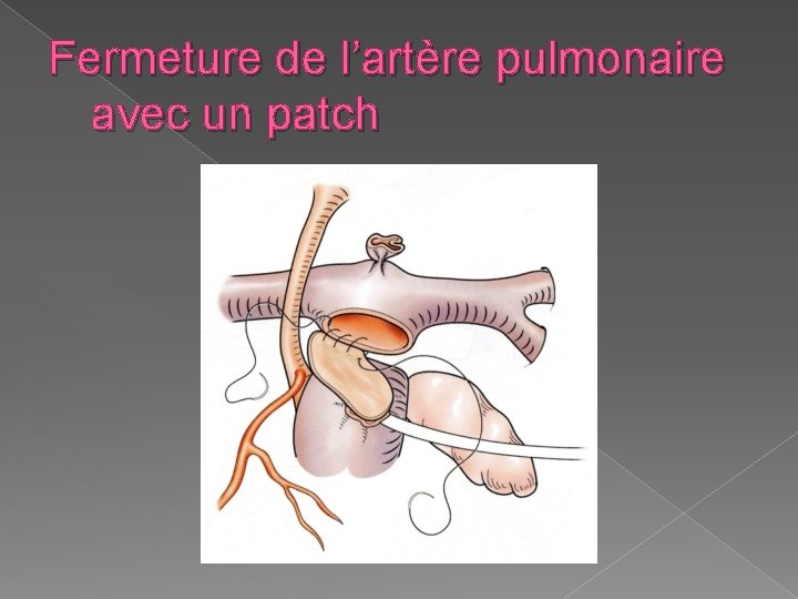 Fermeture de l’artère pulmonaire avec un patch 