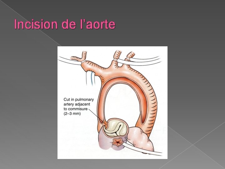 Incision de l’aorte 