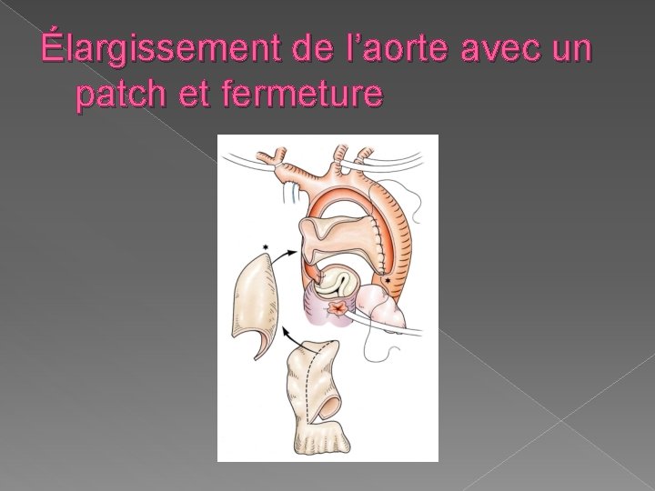 Élargissement de l’aorte avec un patch et fermeture 