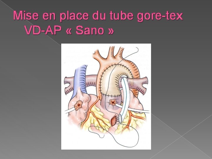 Mise en place du tube gore-tex VD-AP « Sano » 