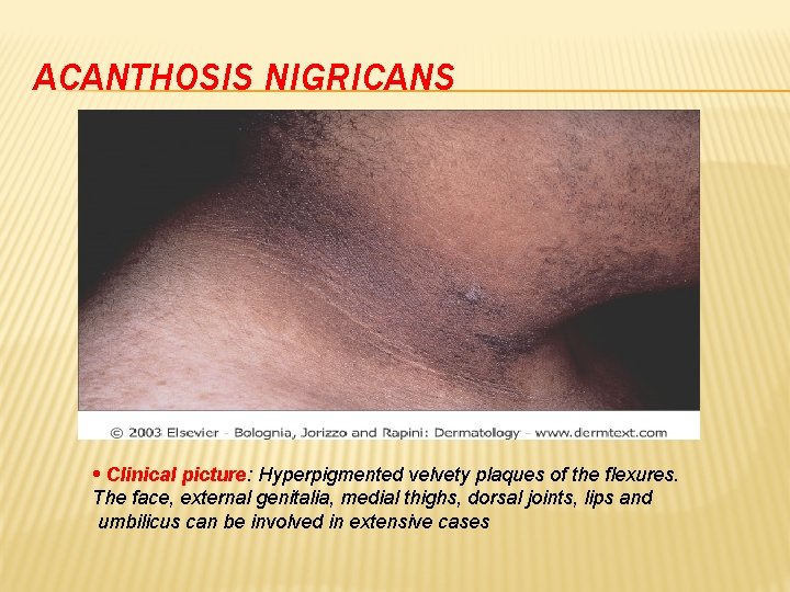 ACANTHOSIS NIGRICANS • Clinical picture: Hyperpigmented velvety plaques of the flexures. The face, external