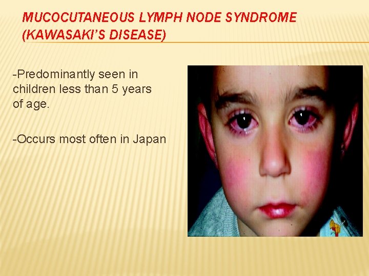 MUCOCUTANEOUS LYMPH NODE SYNDROME (KAWASAKI’S DISEASE) -Predominantly seen in children less than 5 years