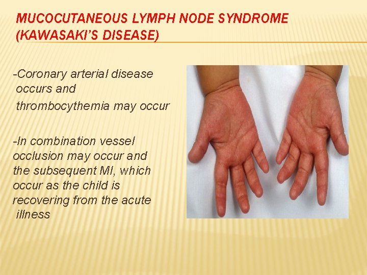 MUCOCUTANEOUS LYMPH NODE SYNDROME (KAWASAKI’S DISEASE) -Coronary arterial disease occurs and thrombocythemia may occur