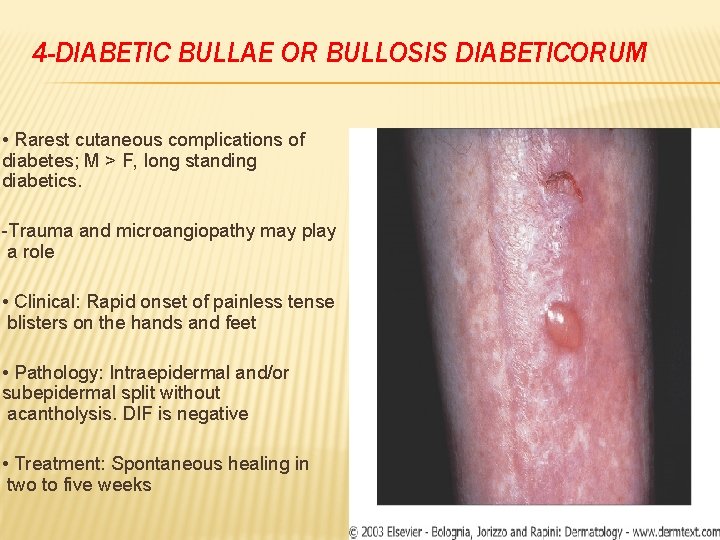 4 -DIABETIC BULLAE OR BULLOSIS DIABETICORUM • Rarest cutaneous complications of diabetes; M >