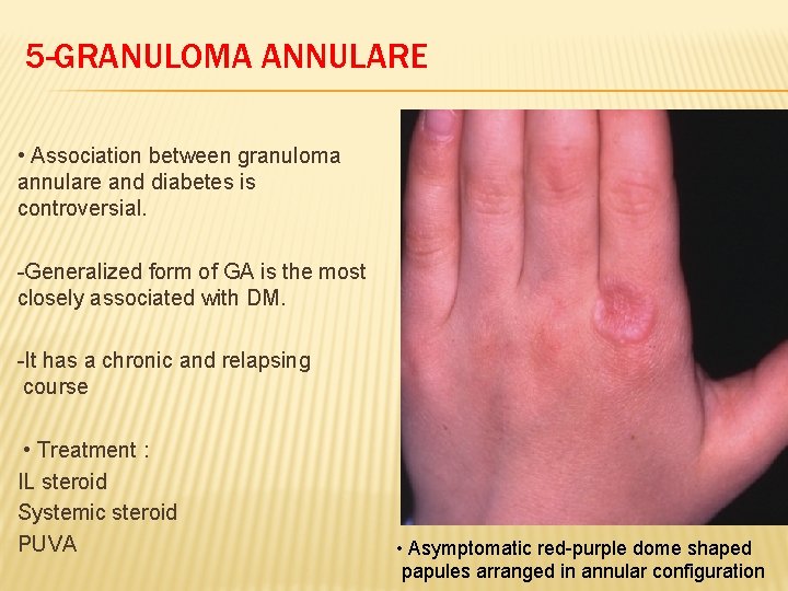 5 -GRANULOMA ANNULARE • Association between granuloma annulare and diabetes is controversial. -Generalized form