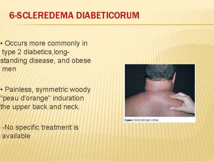 6 -SCLEREDEMA DIABETICORUM • Occurs more commonly in type 2 diabetics, longstanding disease, and