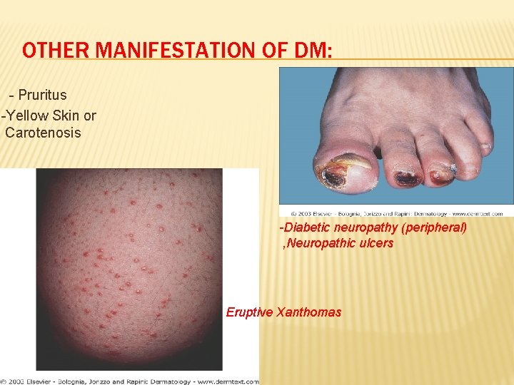 OTHER MANIFESTATION OF DM: - Pruritus -Yellow Skin or Carotenosis -Diabetic neuropathy (peripheral) ,