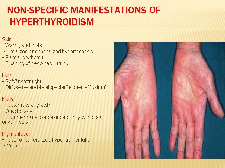 NON-SPECIFIC MANIFESTATIONS OF HYPERTHYROIDISM Skin • Warm, and moist • Localized or generalized hypertrichosis