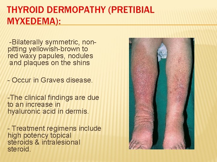 THYROID DERMOPATHY (PRETIBIAL MYXEDEMA): -Bilaterally symmetric, nonpitting yellowish-brown to red waxy papules, nodules and